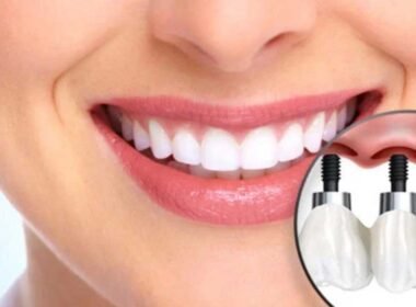 How Dental Implants Can Restore Your Smile and Confidence