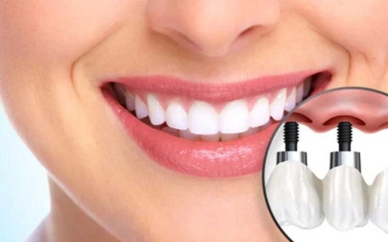 How Dental Implants Can Restore Your Smile and Confidence