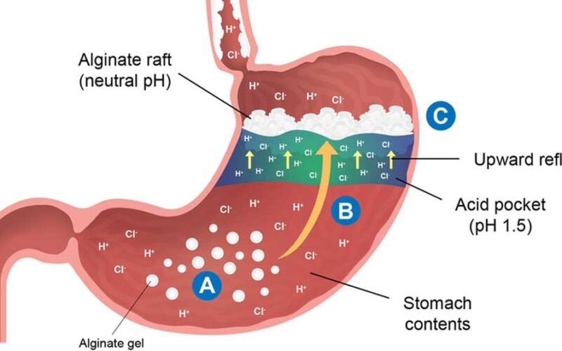 How Alginate Helps Fight Acid Reflux