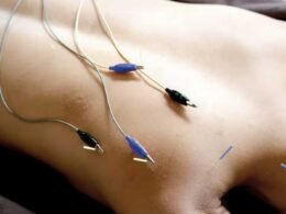 What Is Electroacupuncture and How Can It Help