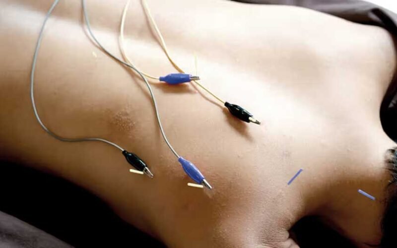 What Is Electroacupuncture and How Can It Help