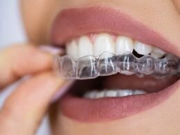 What to Expect During Your First Clear Aligner Appointment in Kelowna