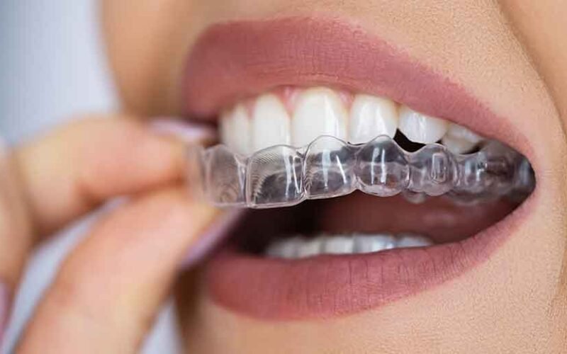 What to Expect During Your First Clear Aligner Appointment in Kelowna