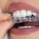 What to Expect During Your First Clear Aligner Appointment in Kelowna